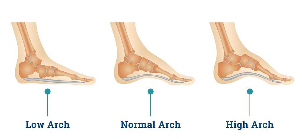 Info graphic of different arch types: low, normal and high